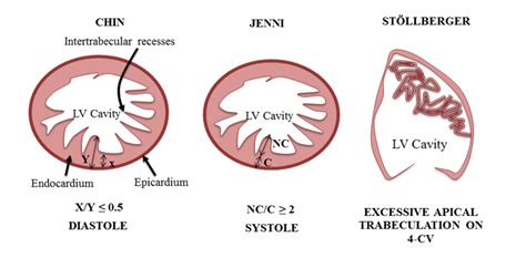 noncompaction cardiomyopathy criteria